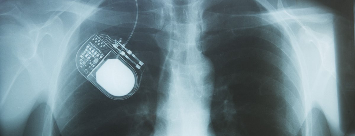 Ultrafine Insulated Wire applied in an implant Medical Grade Utrafine Wire is used in implants